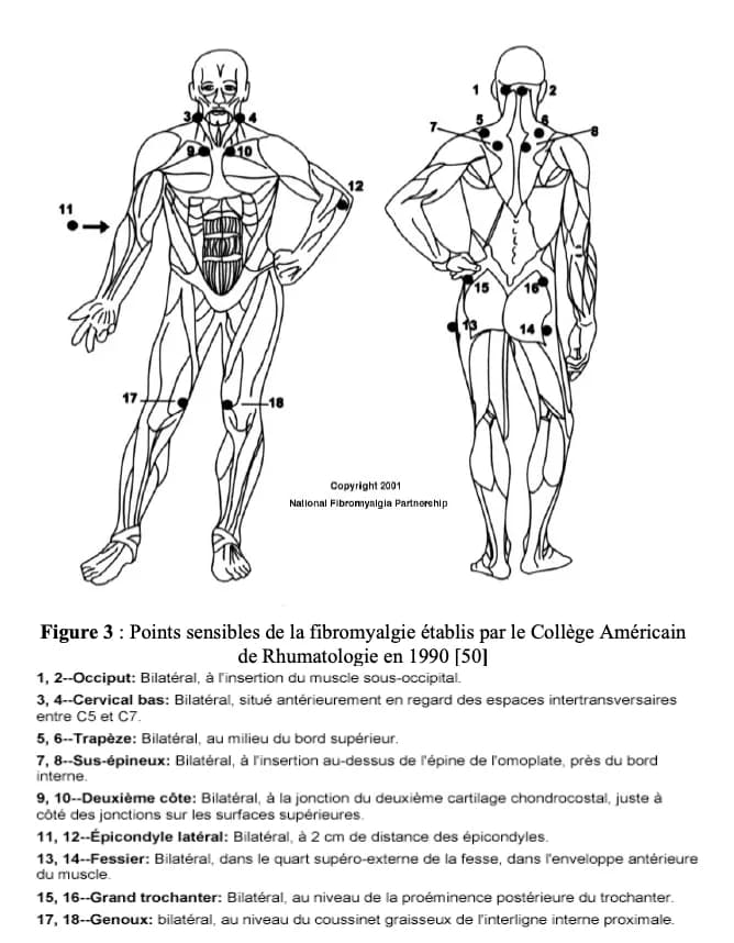 fibromyalgie