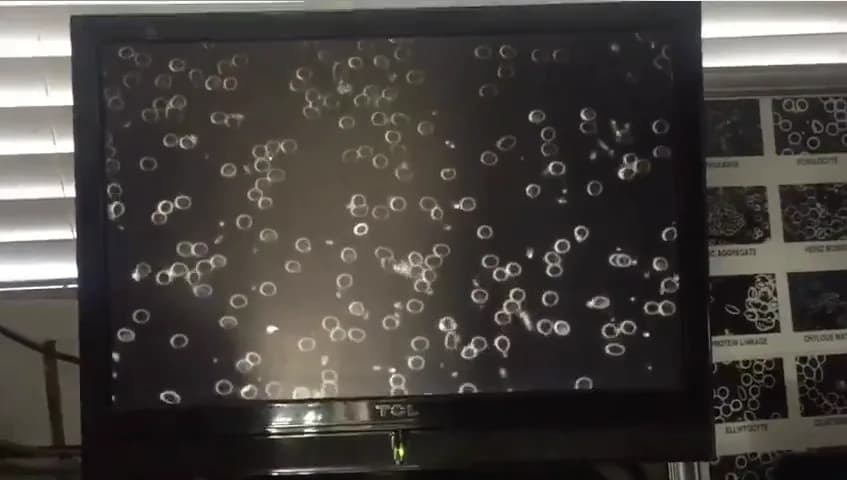 Aspect des globules rouges après 20 minutes de bain de gong